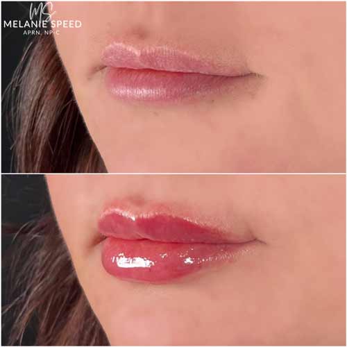 Lip Augmentation by Flawless Medspa