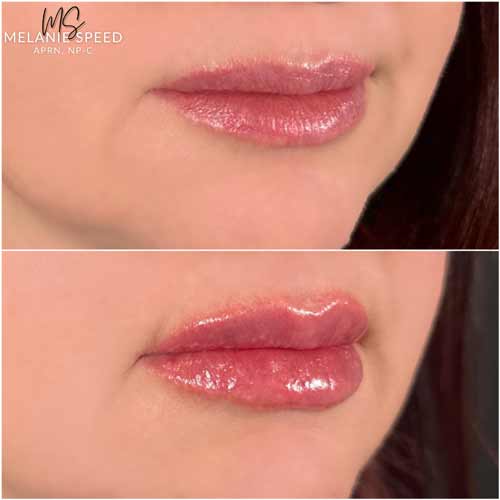 Lip Augmentation by Flawless Medspa