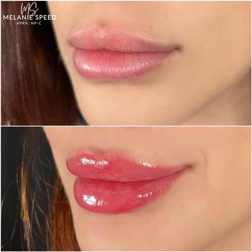 Lip Augmentation by Flawless Medspa