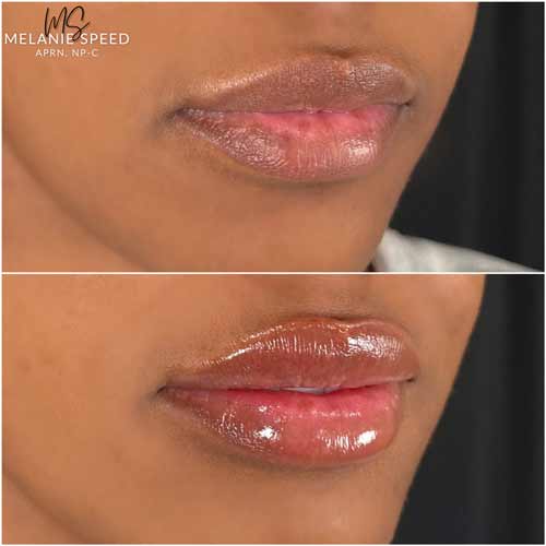 Lip Augmentation by Flawless Medspa