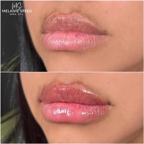 Lip Augmentation by Flawless Medspa