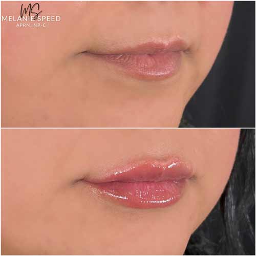 Lip Augmentation by Flawless Medspa