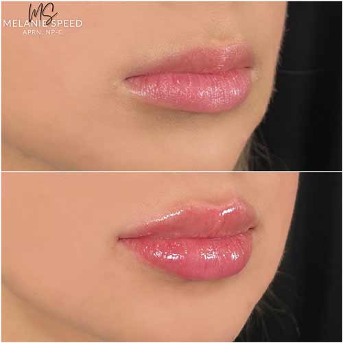 Lip Augmentation by Flawless Medspa