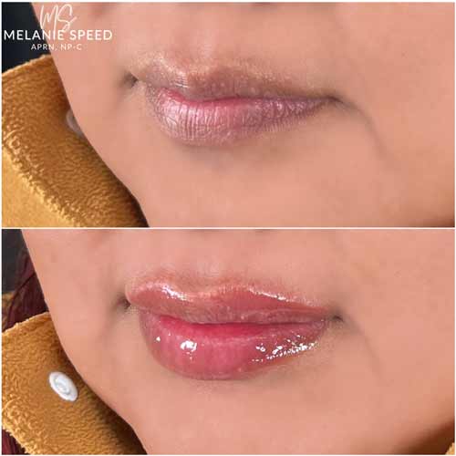 Lip Augmentation by Flawless Medspa