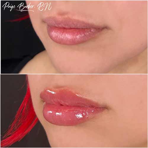 Lip Augmentation by Flawless Medspa