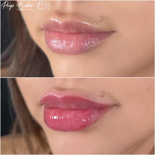 Lip Augmentation by Flawless Medspa