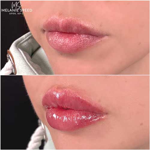 Lip Augmentation by Flawless Medspa