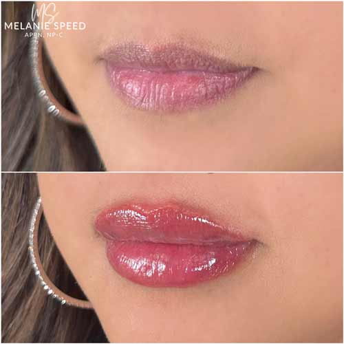 Lip Augmentation by Flawless Medspa