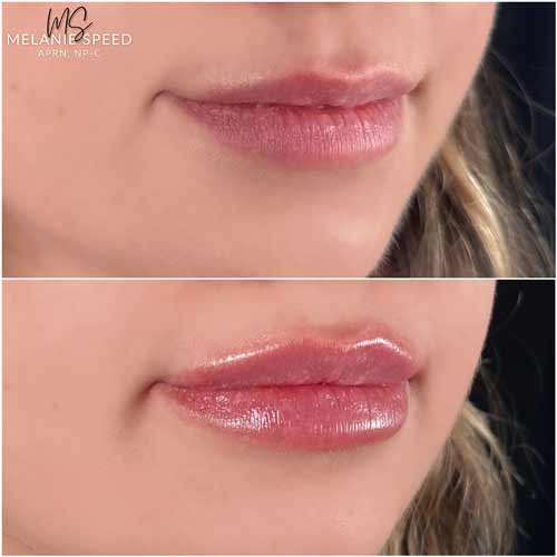 Lip Augmentation by Flawless Medspa