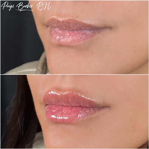 Lip Augmentation by Flawless Medspa