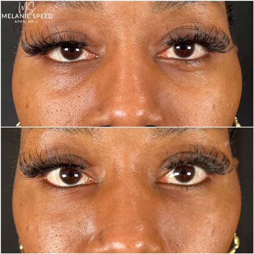 Plasma IQ Skin Treatment for Eyes Wrinkles by Flawless Medspa