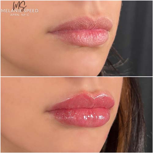 Lip Augmentation by Flawless Medspa