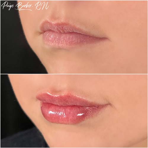 Lip Augmentation by Flawless Medspa