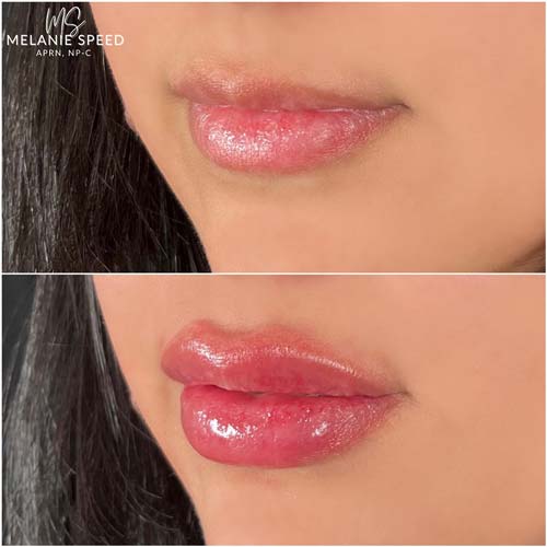 Lip Augmentation by Flawless Medspa