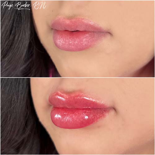 Lip Augmentation by Flawless Medspa