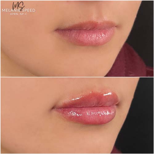 Lip Augmentation by Flawless Medspa