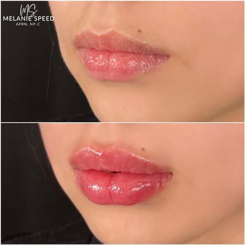 Lip Augmentation by Flawless Medspa