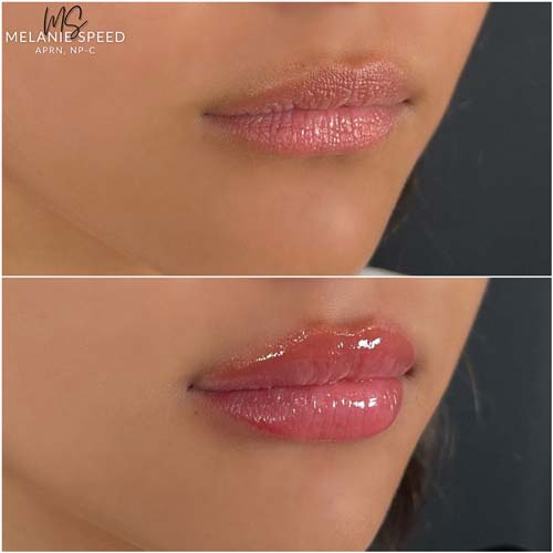 Lip Augmentation by Flawless Medspa