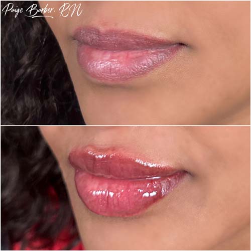 Lip Augmentation by Flawless Medspa