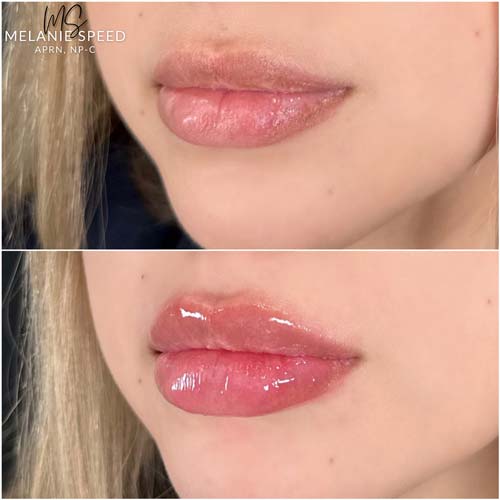 Lip Augmentation by Flawless Medspa