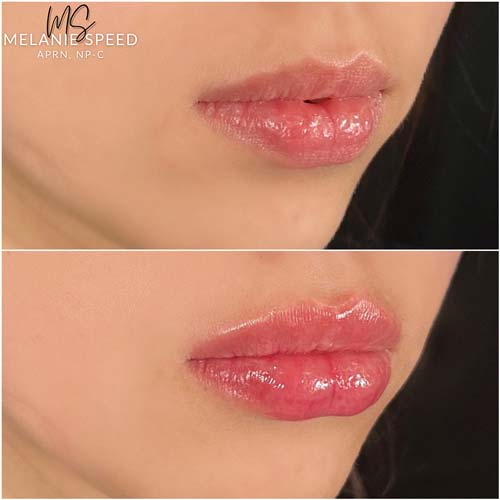 Lip Augmentation by Flawless Medspa