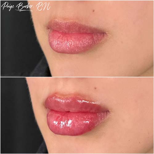 Lip Augmentation by Flawless Medspa