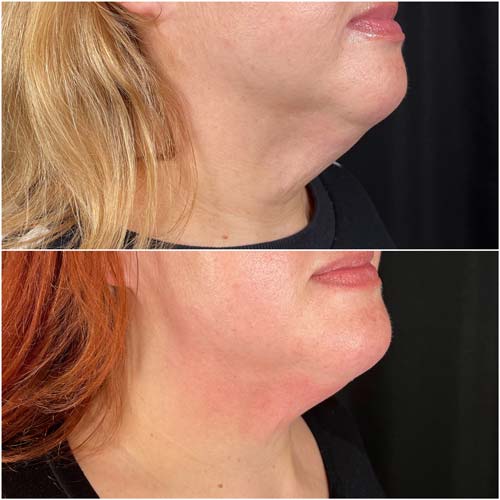 Chin & Jawline Correction by Flawless Medspa