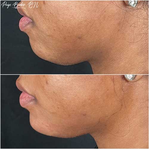 Chin & Jawline Correction by Flawless Medspa