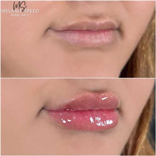 Lip Augmentation by Flawless Medspa