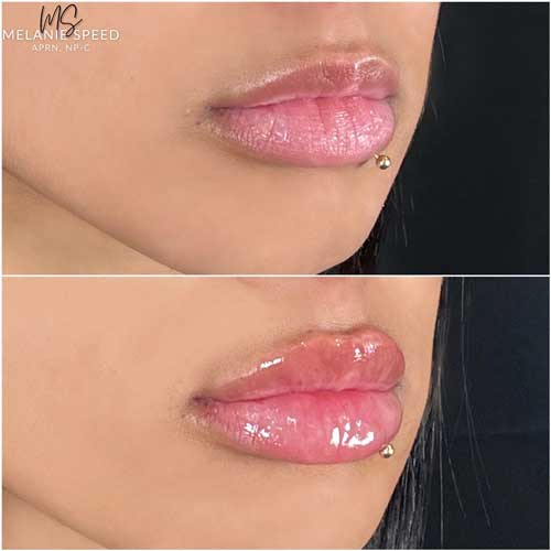 Lip Augmentation by Flawless Medspa