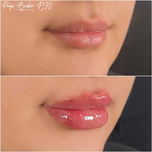 Lip Augmentation by Flawless Medspa