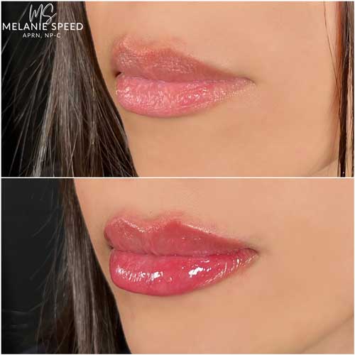 Lip Augmentation by Flawless Medspa