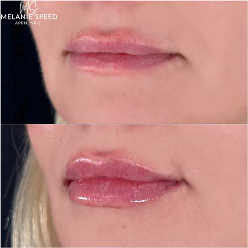 Lip Augmentation by Flawless Medspa