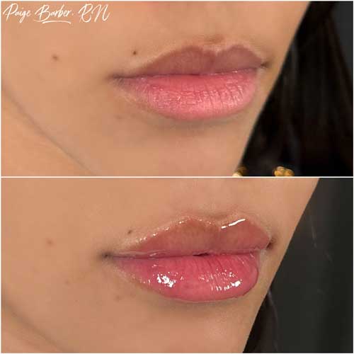 Lip Augmentation by Flawless Medspa