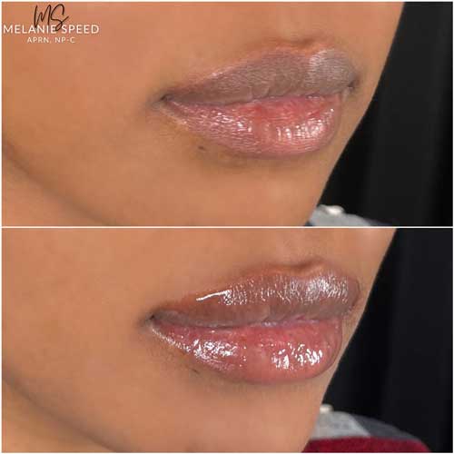 Lip Augmentation by Flawless Medspa