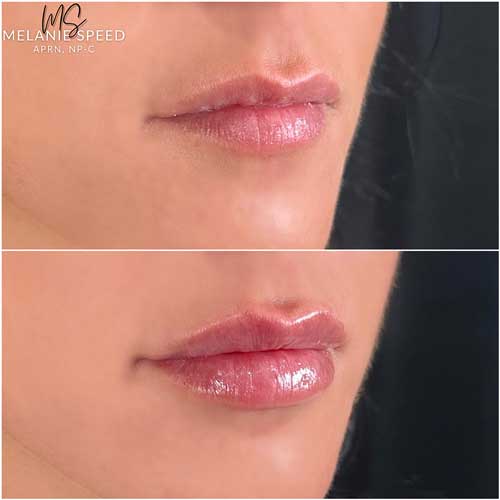 Lip Augmentation by Flawless Medspa