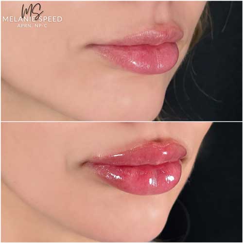 Lip Augmentation by Flawless Medspa