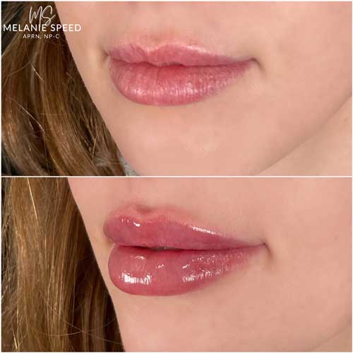 Lip Augmentation by Flawless Medspa