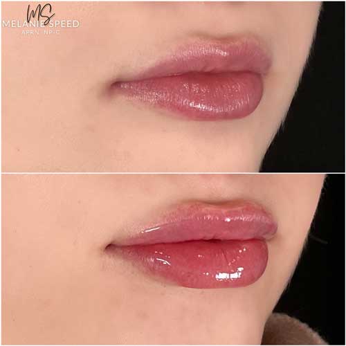 Lip Augmentation by Flawless Medspa