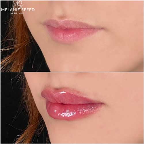 Lip Augmentation by Flawless Medspa