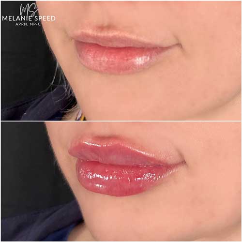 Lip Augmentation by Flawless Medspa