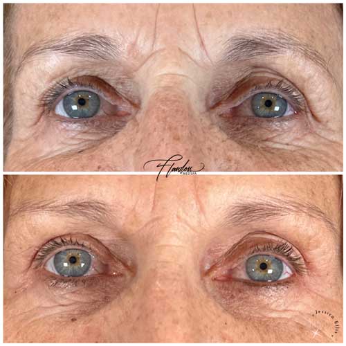 Scarlet SRF Treatment Specialist Near Me in Las Vegas, NV Scarlet SRF Treatment Specialist Near Me in Las Vegas, NV