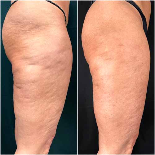 Scarlet SRF Treatment Specialist Near Me in Las Vegas, NV Scarlet SRF Treatment Specialist Near Me in Las Vegas, NV