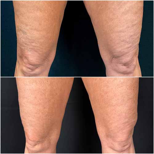 Scarlet SRF Treatment Specialist Near Me in Las Vegas, NV Scarlet SRF Treatment Specialist Near Me in Las Vegas, NV