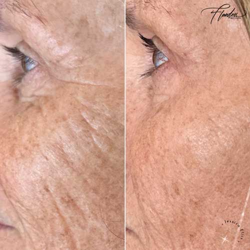 Sculptra Facial Rejuvenation by Flawless Medspa