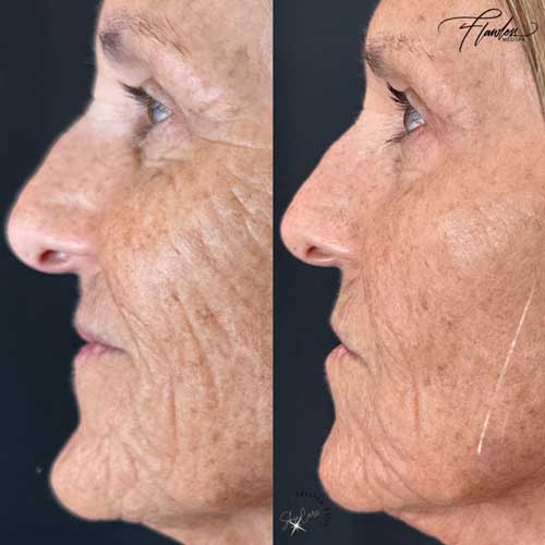 Skin Facial Rejuvenation by Flawless Medspa