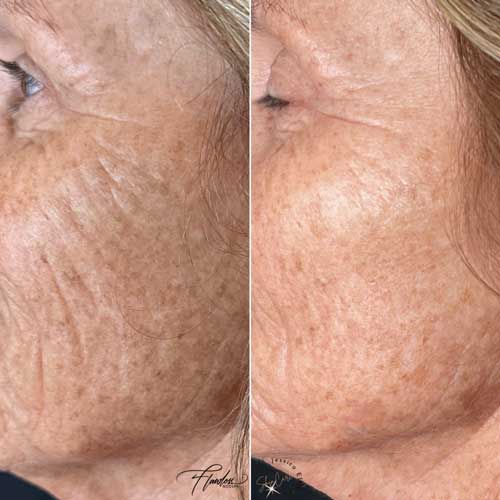 Sculptra Facial Rejuvenation by Flawless Medspa