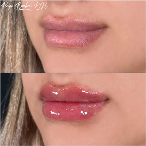 Lip Augmentation by Flawless Medspa