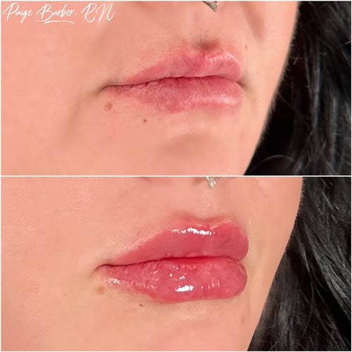 Lip Augmentation by Flawless Medspa