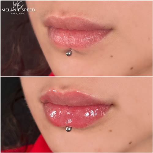 Lip Augmentation by Flawless Medspa